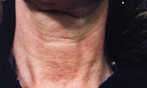 Environ After Skin's elasticity and structural integrity has improved tremendously after 24 Environ's Active Vitamin Facial Treatments.