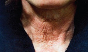 Environ Before Before Active Vitamin Facial Treatments. Treating loss of structural integrity and elastosis.