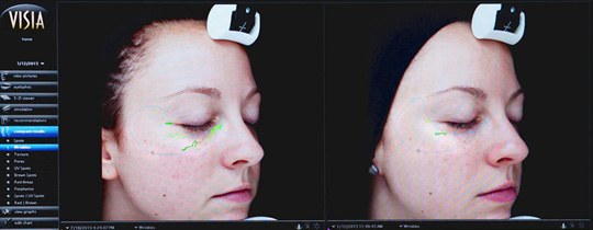 Visia Skin Analysis at Unique Verve in Boston, environ products