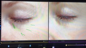 Facial Improvement Pictures - pictures taken before and right after the facial
