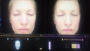 Facial Before and After Pictures - Reduction in Pore Size and Pore Count