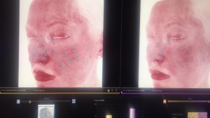 Facial Improvement Pictures - Reduction in Redness