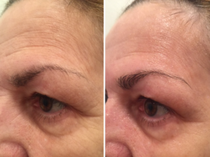 Anti Aging Skincare Treatment in Boston at Unique Verve