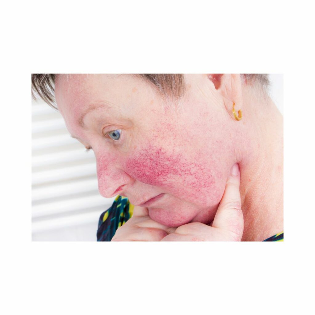 Rosacea